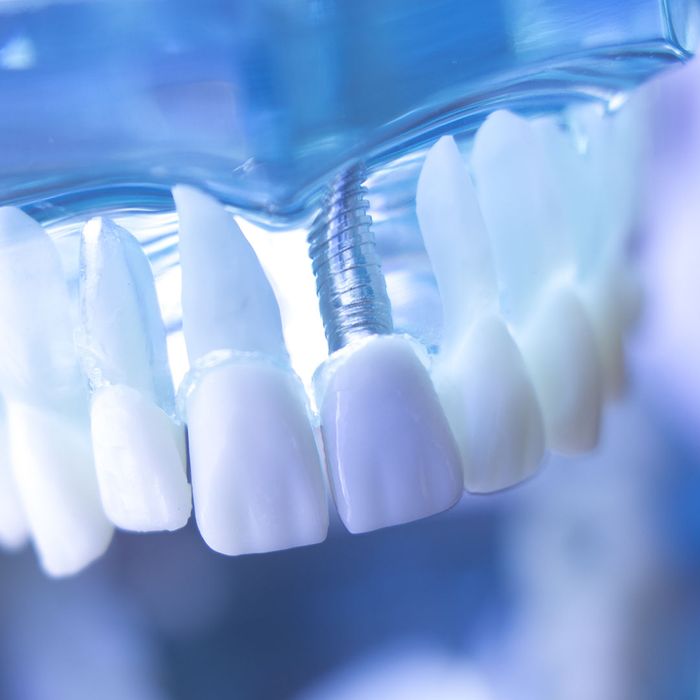 Veneers vs Implants How They Differ Boulder Smiles Dentist Boulder